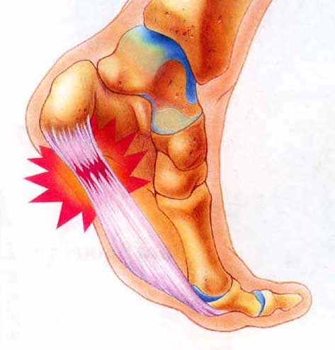  بیماری کف پا,التهاب غلاف کف پا,درمان بیماری های پا 